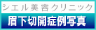 シエル美容クリニック院長ブログ-眉下切開