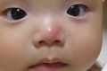 鼻の頭を蚊に刺されて痛そう